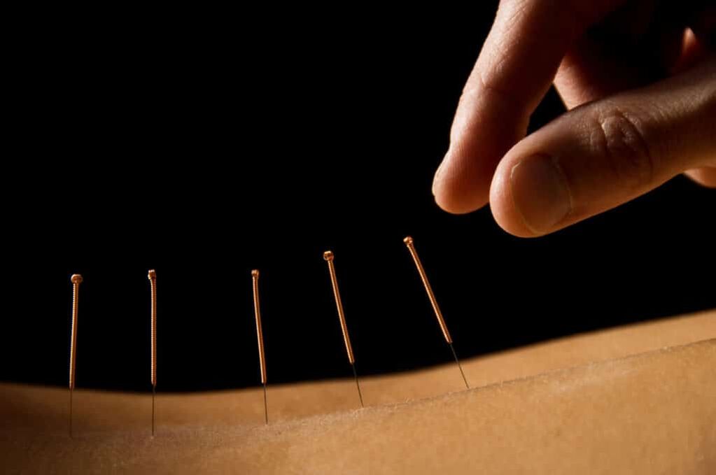 Akupunktur bei Prostataentzündung