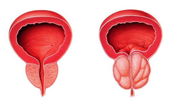 Normale und entzündete Prostata (Prostatitis)