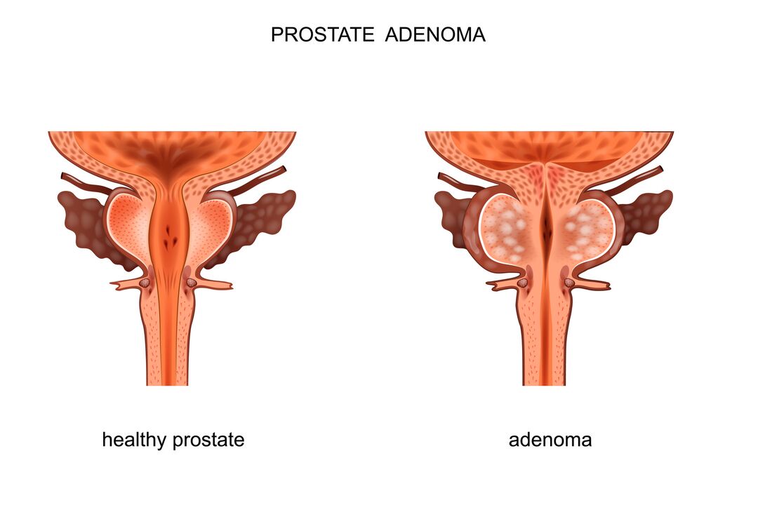 Gesunde Prostata und Adenom