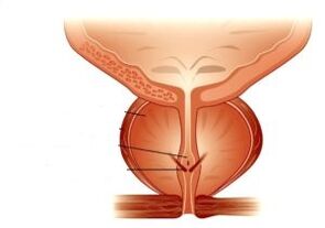 Prostatitis und ihre Behandlung mit Medikamenten
