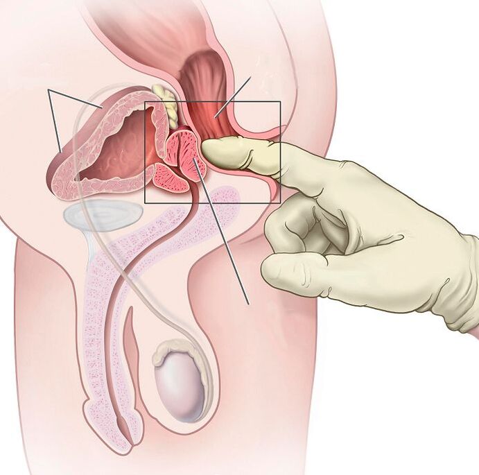 Prostatamassage zur Behandlung von Prostatitis