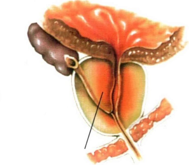 Entzündung des Prostatagewebes bei chronischer Prostatitis